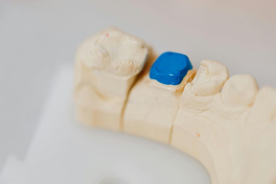 Implantat mit Keramikkrone: Kosten und ästhetische Vorteile